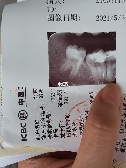 拔智齿要多少钱？看完这篇文章你就知道了