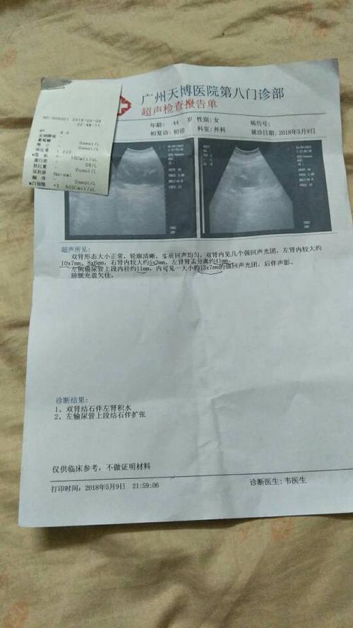 医院打结石要多少钱？影响因素有哪些？