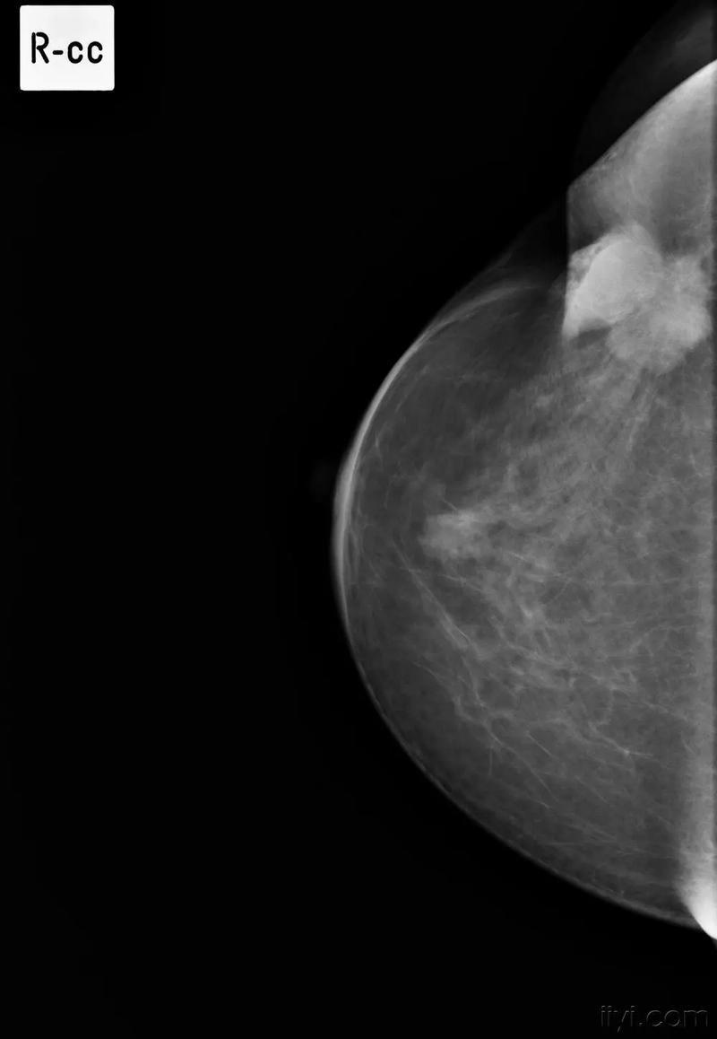 乳腺检查做钼靶多少钱？